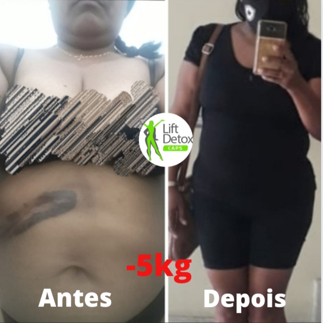 imagem:  lift detox caps antes e depois, lift detox caps bula, lift detox caps contraindicações, lift detox caps para que serve, lift detox caps reclamações, lift detox caps como tomar, lift detox caps como funciona, lift detox caps preço,