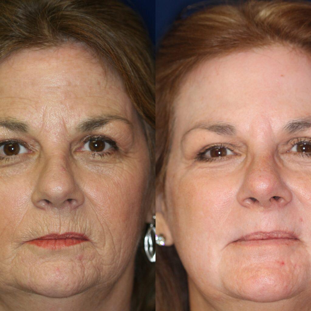 acido hialuronico antes e depois