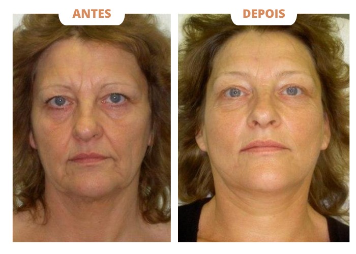 acido hialuronico antes e depois